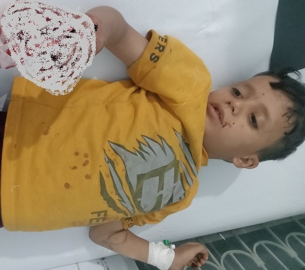 إصابة طفل بانفجار جسم متفجر من مخلفات مليشيا إيران في تعز