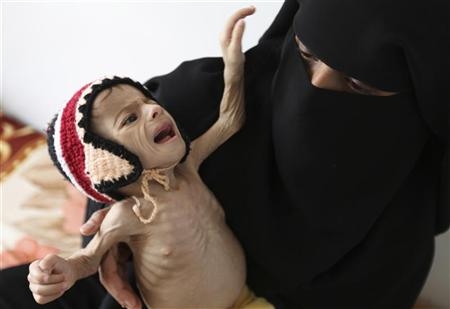 منظمة دولية: ثلاث محافظات تحت حكم المليشيا تظهر فيها المجاعة