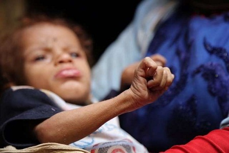 7 ملايين يمني يعانون من هذا المرض الخطير