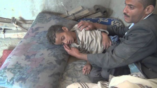 تسجيل 33 حالة وفاة بداء الكلب في صنعاء